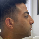 Facial Liposculpture Before & After Patient #4477