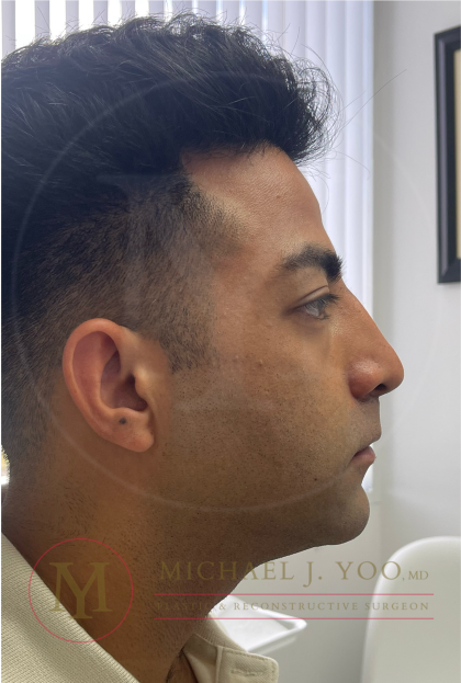 Facial Liposculpture Before & After Patient #4477