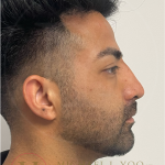 Facial Liposculpture Before & After Patient #4477