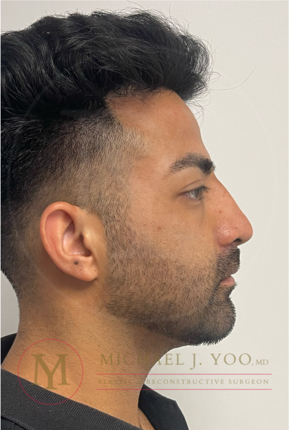 Facial Liposculpture Before & After Patient #4477