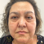 Upper Eyelid Lift Before & After Patient #4511