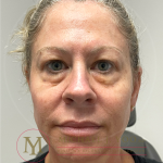 Upper Eyelid Lift Before & After Patient #4510