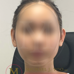 Otoplasty Before & After Patient #4516