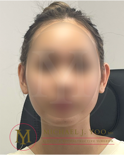 Otoplasty Before & After Patient #4516