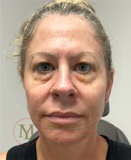 Upper Eyelid Lift Before & After Patient #4510