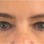 Upper Eyelid Lift Before & After Patient #4503