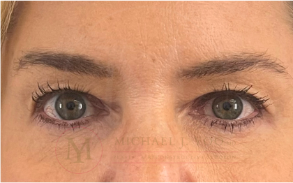 Upper Eyelid Lift Before & After Patient #4503