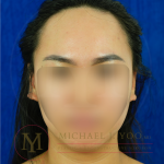 Forehead Reduction Before & After Patient #4519