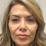 Upper Eyelid Lift Before & After Patient #4502