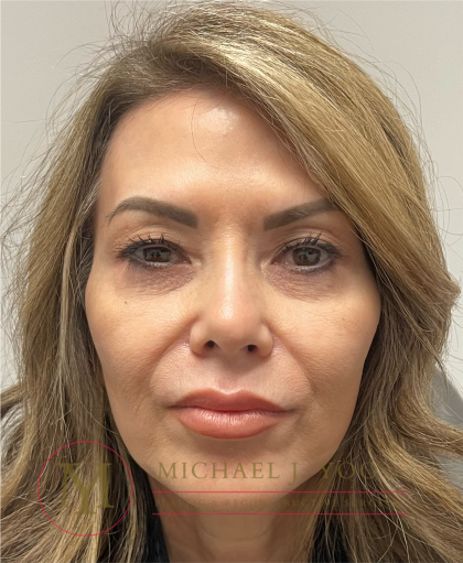 Upper Eyelid Lift Before & After Patient #4502