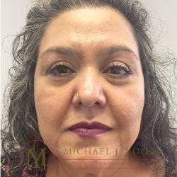 Upper Eyelid Lift Before & After Patient #4511