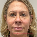 Upper Eyelid Lift Before & After Patient #4510