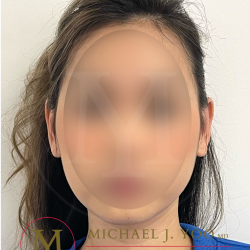 Otoplasty Before & After Patient #4516