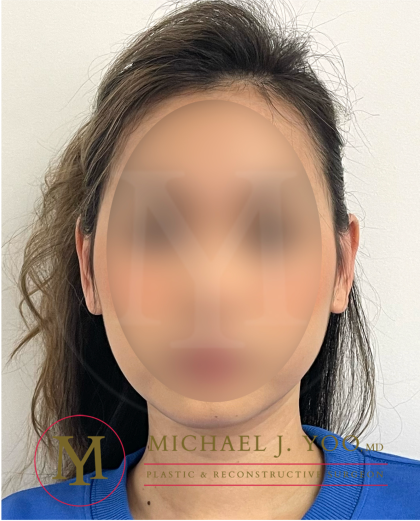 Otoplasty Before & After Patient #4516