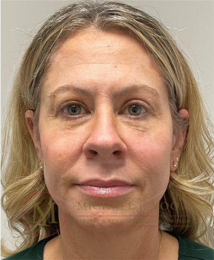 Upper Eyelid Lift Before & After Patient #4510