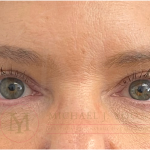 Upper Eyelid Lift Before & After Patient #4503