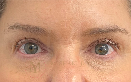 Upper Eyelid Lift Before & After Patient #4503