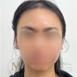 Forehead Reduction Before & After Patient #4519