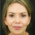 Upper Eyelid Lift Before & After Patient #4502