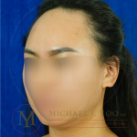 Forehead Reduction Before & After Patient #4519