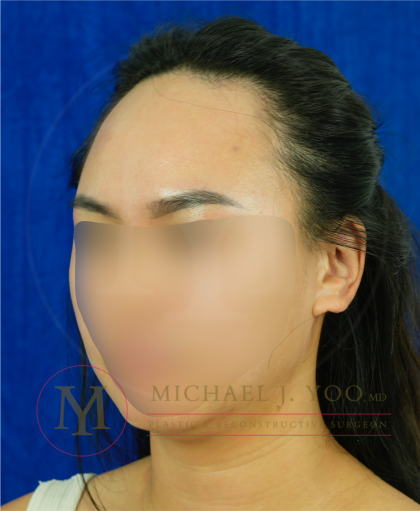 Forehead Reduction Before & After Patient #4519