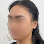 Forehead Reduction Before & After Patient #4519