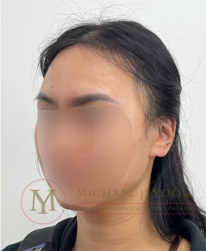 Forehead Reduction Before & After Patient #4519