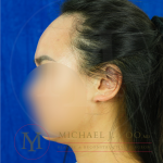 Forehead Reduction Before & After Patient #4519