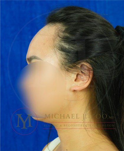 Forehead Reduction Before & After Patient #4519