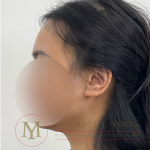 Forehead Reduction Before & After Patient #4519