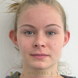 Otoplasty Before & After Patient #4533