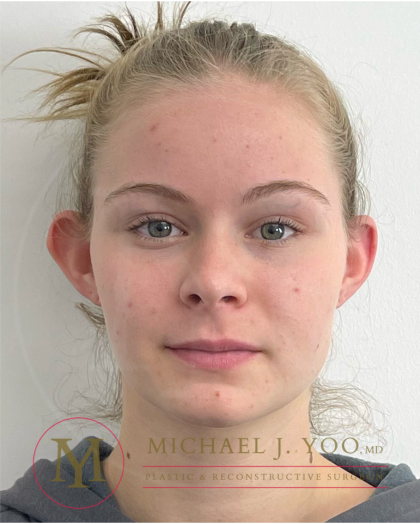 Otoplasty Before & After Patient #4533