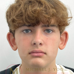 Otoplasty Before & After Patient #4530