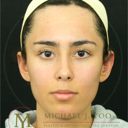 Forehead Reduction Before & After Patient #4534