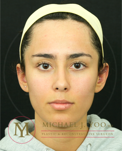 Forehead Reduction Before & After Patient #4534
