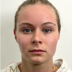 Otoplasty Before & After Patient #4533