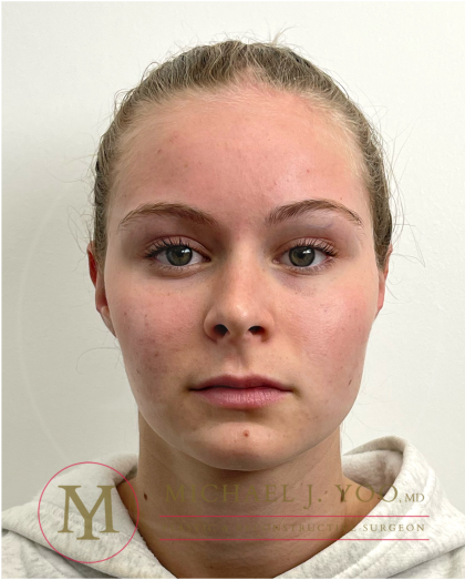 Otoplasty Before & After Patient #4533