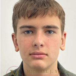 Otoplasty Before & After Patient #4530