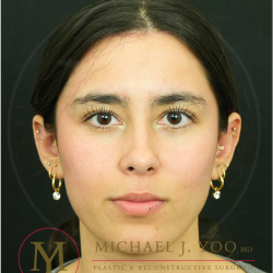 Forehead Reduction Before & After Patient #4534