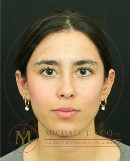 Forehead Reduction Before & After Patient #4534