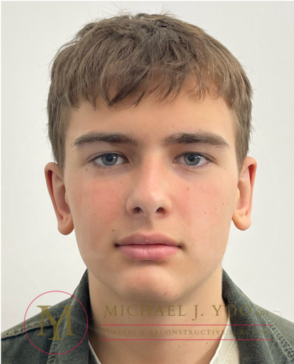 Otoplasty Before & After Patient #4530