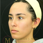 Forehead Reduction Before & After Patient #4534