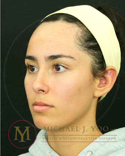 Forehead Reduction Before & After Patient #4534