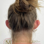 Otoplasty Before & After Patient #4533