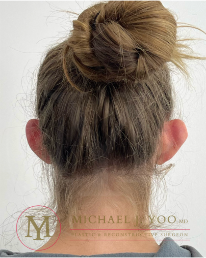 Otoplasty Before & After Patient #4533