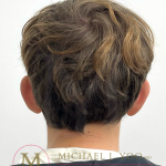 Otoplasty Before & After Patient #4530