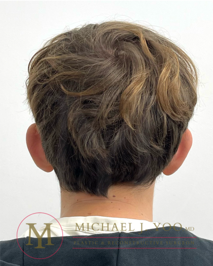 Otoplasty Before & After Patient #4530