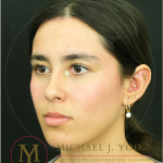 Forehead Reduction Before & After Patient #4534