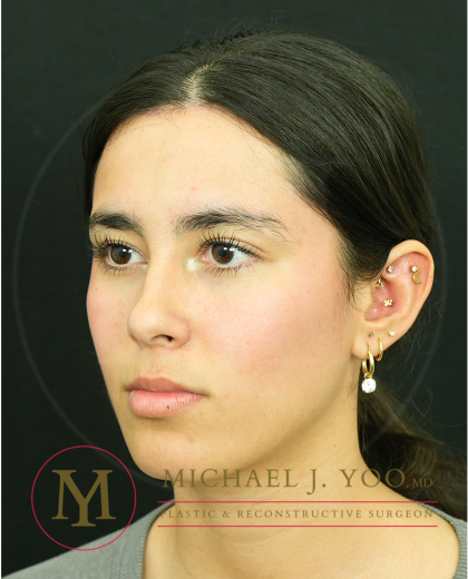 Forehead Reduction Before & After Patient #4534