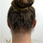 Otoplasty Before & After Patient #4533